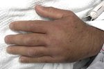 Angioedema of hand