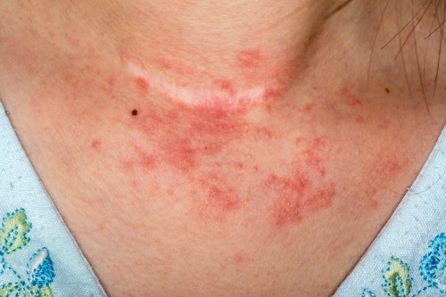 Can I Treat My Rash With Over-the-Counter Medication?: Advanced Allergy and  Asthma: Allergists